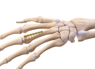 Arthrex - Compression FT Screw, 2.5 Micro, 40 mm Length - AR-8725-40H